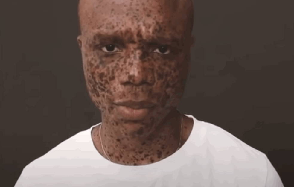 NEOBIČNO OBIČNI: Oni su ljudi koji su rođeni sa 'drugačijom' bojom kože koja je njihov najveći ADUT (VIDEO) 